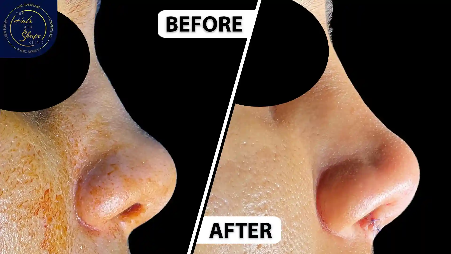 Rhinoplasty result9